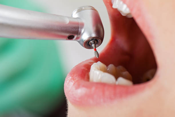 Best Emergency Dental Care for Broken or Chipped Teeth in Hanover Park, IL